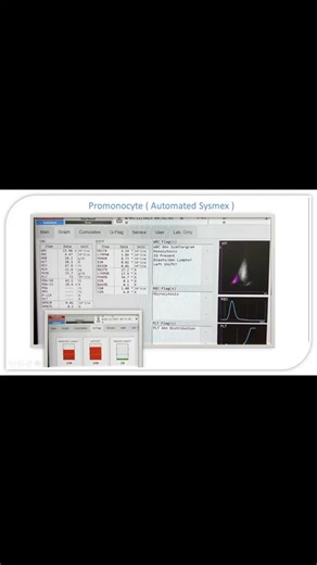 Rose Apple on Instagram: "💐 AML M5 (Acute Monocytic Leukemia) or Acute Monocytic/Myelomonocytic Leukemia (FAB M5)💐 🍁 subtype of Acute Myeloid Leukemia (AML) characterized by the proliferation of Monoblasts and Promonocytes. 🍁 Key Features FAB Classification 🔸M5a (Acute Monoblastic Leukemia) → Monoblasts > 80% of Monocytic cells → More common in children and young adults → Cells are large, with round nuclei, fine chromatin, and prominent nucleoli → Frequently associated with bleeding, gum hy