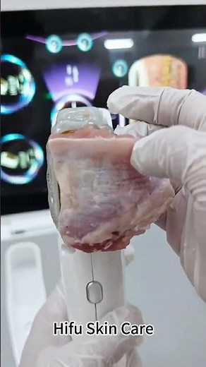 What does the HIFU machine do?