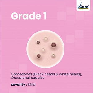 11 reactions | Which grade of acne do you have? comment us below! #VCareClinics #VCareSkinCare #SkinCare #AcneGrades #Acne #Pimples #SkinCareExpert #Makeup #HomeRemedies #Facescrub | VCare | Facebook