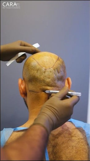 Designing the Perfect Masculine Hairline