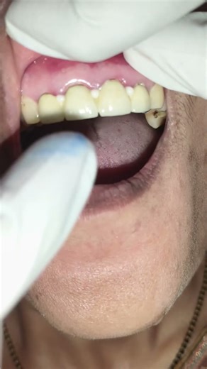 fixed cap bridge 🦷#teeth #dentist #toothcap #dental #shorts