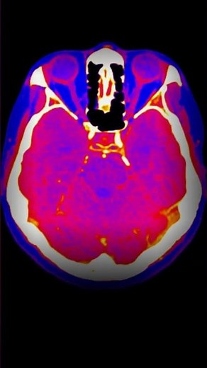 Neanderthal Brains Were Different