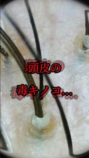 頭皮ケアのプロが角栓除去をお伝えします。人生を変えるケアクレンジング#shorts
