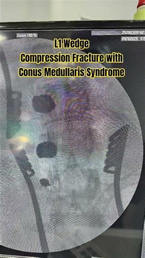 How is Spine Vertebral Body Fracture with Nerve Compression fixed?