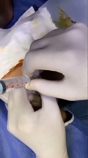 Landmark technique: Mandibular Nerve Block