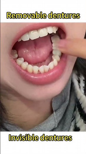 Invisible dentures #removabledenture