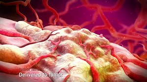 PRRT国外最全面的PRRT免疫疗法视频介绍