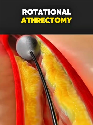 How Rotational Atherectomy is done ? (3D Animations) #rotationalatherectomy #rotationplastyawareness #heart #heartdiseaseawareness #medicalanimation
