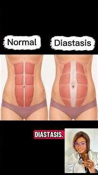 Diastasis après grossesse et Test de diastasis👌