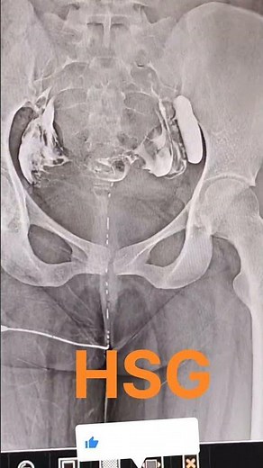 HSG Procedure#radiology