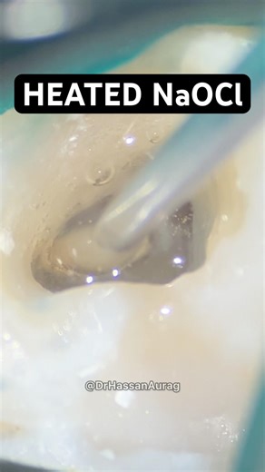 This Reaction Cleans Root Canals Better 🔥🦷