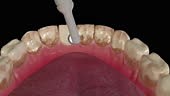 This video shows the dental scaling procedure
