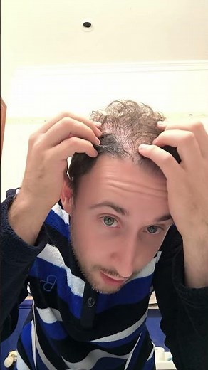 Día 1 Probando Minoxidil para el tratamiento de la alopecia