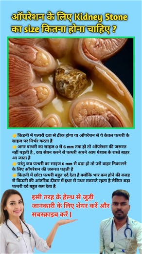 ऑपरेशन के लिए Kidney Stone का size कितना होना चाहिए ? Kidney stone removal process || #viral