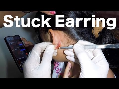 Earring Stuck Inside Her Earlobe for Months | How It's Removed