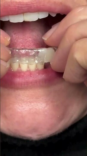 🦷 How to Use an Essix Retainer