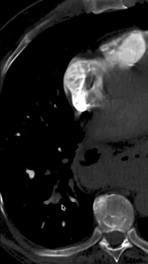 Learn how to read CTPA. Essential diagnosis for ED, critical care, urgent care medical professionals