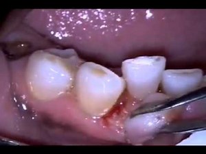 l'exérèse de l'épulis