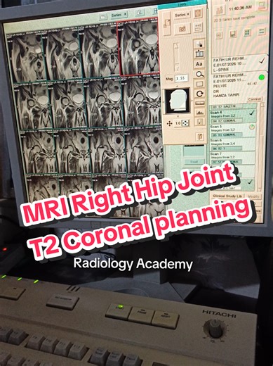 “T2-weighted Coronal Planning of the Right Hip Joint (MRI)” #Radiologyacademy #mri #ctscan #radiology #hospital