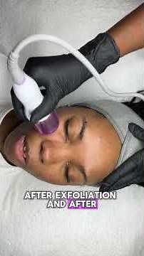 From Dull to Radiant! See How This All-in-One Hydro Dermabrasion Machine Transforms Skin 🌸