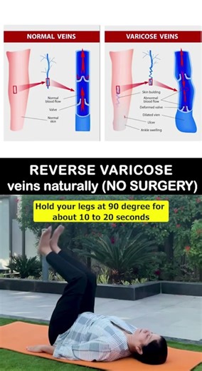Varicose veins don’t improve overnight, but the right daily movements can support better circulation
