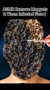 ASMR Remove Maggots & Worm Infected Face | Deep Cleaning | #video #reels #treatment #viral #trending #cleaning #asmr #foryou | Akhilesh Yadav