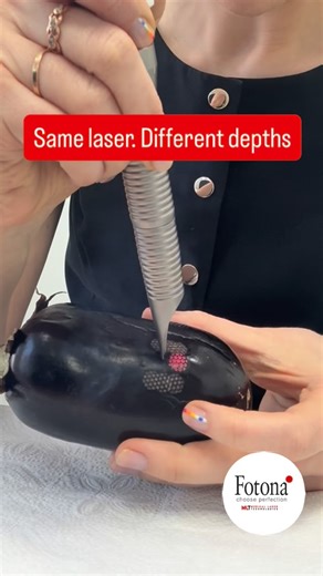 Anna | Aesthetic Nurse on Instagram: "Eggplant today… new skin tomorrow 🍆✨ This is how @fotona_international SP Dynamis Max treats the skin: 🔹 Medium pattern ablation – partial skin removal 🔹 Full ablation (superficial) – surface resurfacing 🔹 Full ablation (medium) – deeper resurfacing 🔹 Fractional – 81 micro-channels for collagen stimulation Depth and pattern are selected based on the desired treatment outcome. Eggplant is used to demonstrate laser–tissue interaction similar to human skin