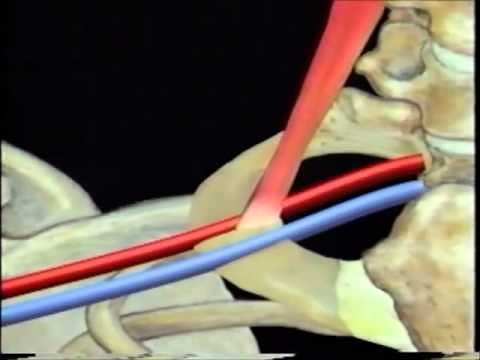 Tunneled Hickman Catheter Insertion BARD