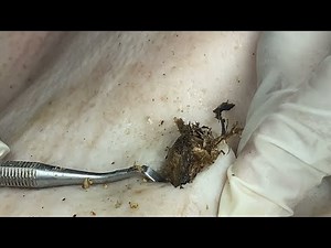 [ASMR] 擠粉刺 超爽快 Sharp Ingrown Trimmed! DR LEE’S Pimple popping with Cystic 2009M2 0392