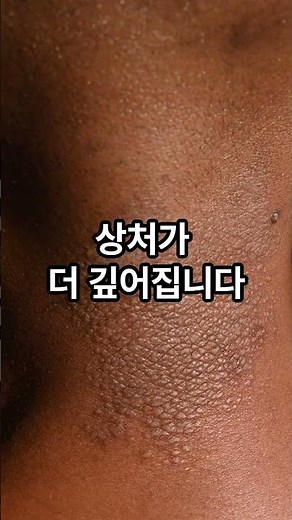 욕창 빨리 낫는 가장 중요한 방법 1위 이것입니다#욕창관리#체위변경#욕창예방#시니어간병#건강정보 #시니어건강 #지식 #대사질환 #이슈 #올바른정보 #증량 #증량 #혈관건강#노년건강