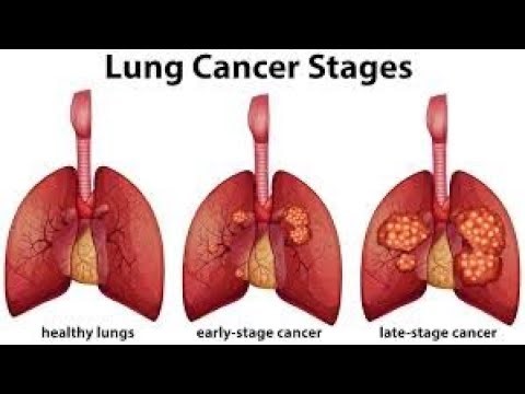 Human Anatomy & Physiology; Lung Tumors:- 118. #lungtumers #lungcancer #neet #medical
