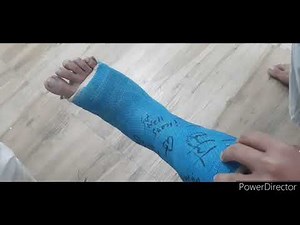 And that's how I removed my plaster | Lightweight Permanent Plaster For Fractured Leg