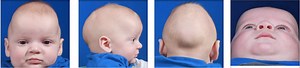 Craniosynostosis causes, symptoms, treatment & craniosynostosis surgery