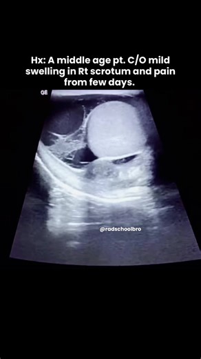 Understanding Scrotal Swelling and Pain in Middle-Aged Patients