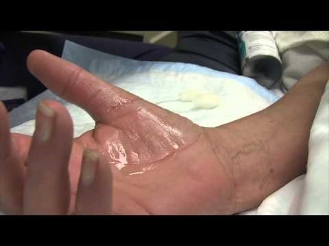 Trigger Finger Injection Therapy