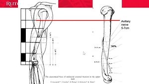 Upper Extremity External Fixation