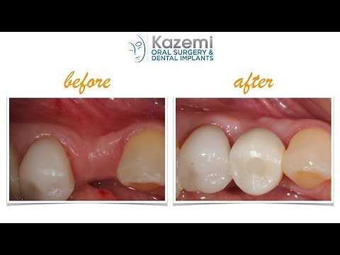 Ridge Expansion with Densah Osseodensification Burs And Dental Implant with Bone Graft