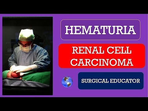 RENAL CELL CARCINOMA - How To DIAGNOSE & TREAT /HEMATURIA