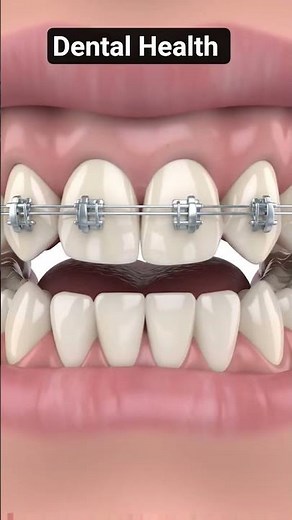3D Orthodontic Braces Treatment Animation – Teeth Alignment in 5 Seconds