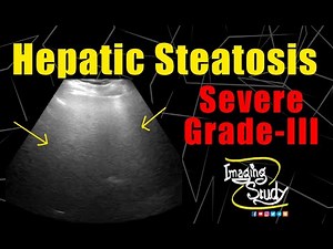 Severe Hepatic Steatosis || Severe Fatty Infiltration || Ultrasound || Case 172