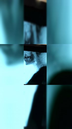 吞咽功能障碍患者吞咽造影检查