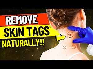 What are Skin Tags and How to Naturally Remove Them ? #healthylifestyle