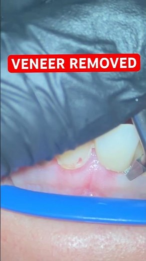 Removing a Dental Veneer in Seconds! 😱 | Crown & Bridge Remover Tool #dentist #shorts #shortsfeed