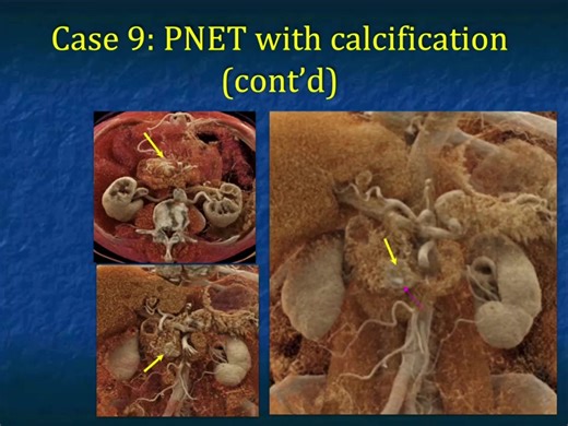 PNET with calcification From "Typical and Atypical Appearances of Pancreatic Neuroendocrine Tumors (PNETs): Role of CT Angiography (CTA) and Cinematic Rendering (CR) - Part 2" View the lecture here: https://www.ctisus.com/media/2023/03/13/typical-and-atypical-appearances-of | CTisus: Cutting edge information on body CT (Computed tomography).