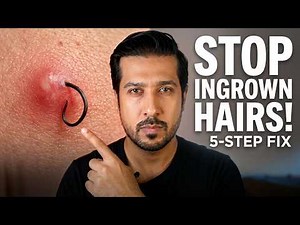 Stop Ingrown Hairs | Ingrown Hair Removal - 5 STEPS