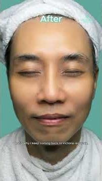 8 Years in the Same Facial Centre? How?! | Victoria Facelift Review