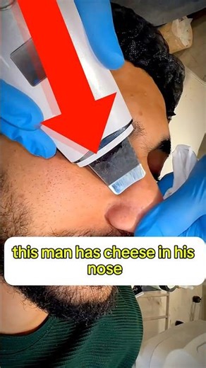 Doctors Thought It Was Cheese… But It Was 24 Years of Nose Buildup 😳👃
