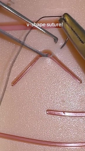 V-Shape Suture Technique for High School Students