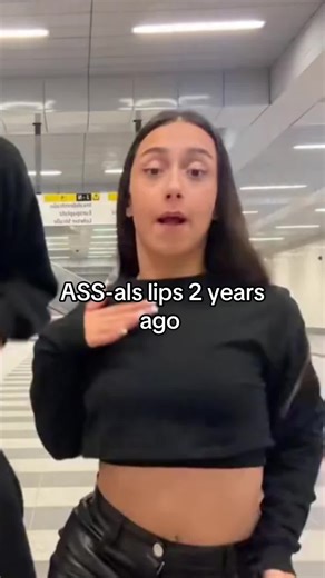 Lip Filler Transformation: A Look at ASS-al's Journey