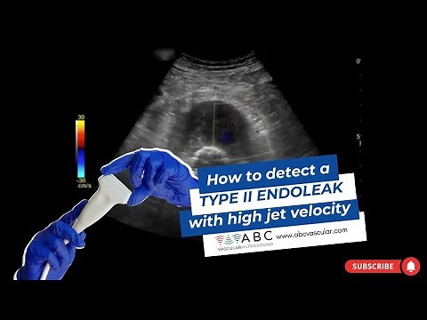 How to detect an endoleak: type II endoleak with high jet velocity. Ultrasound of EVAR